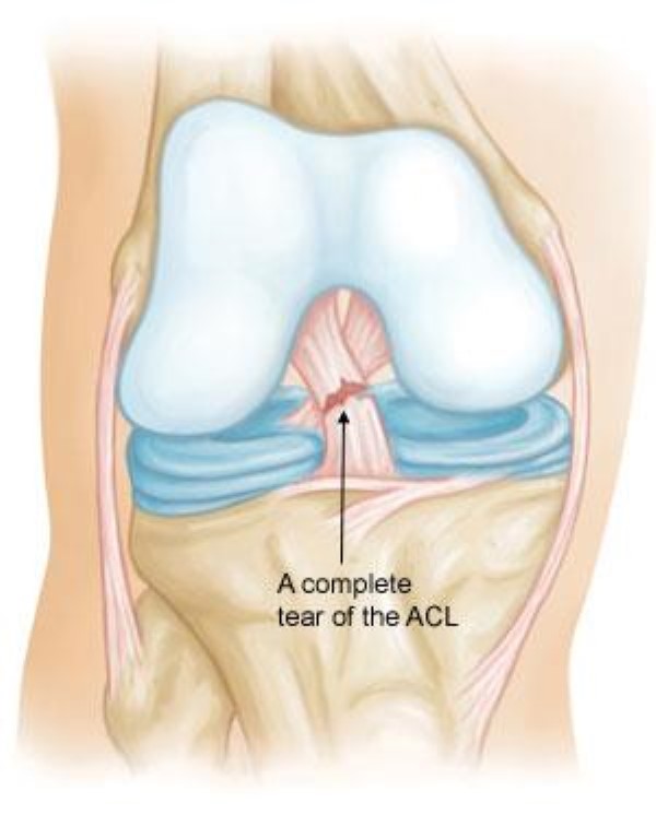 ACL rupture