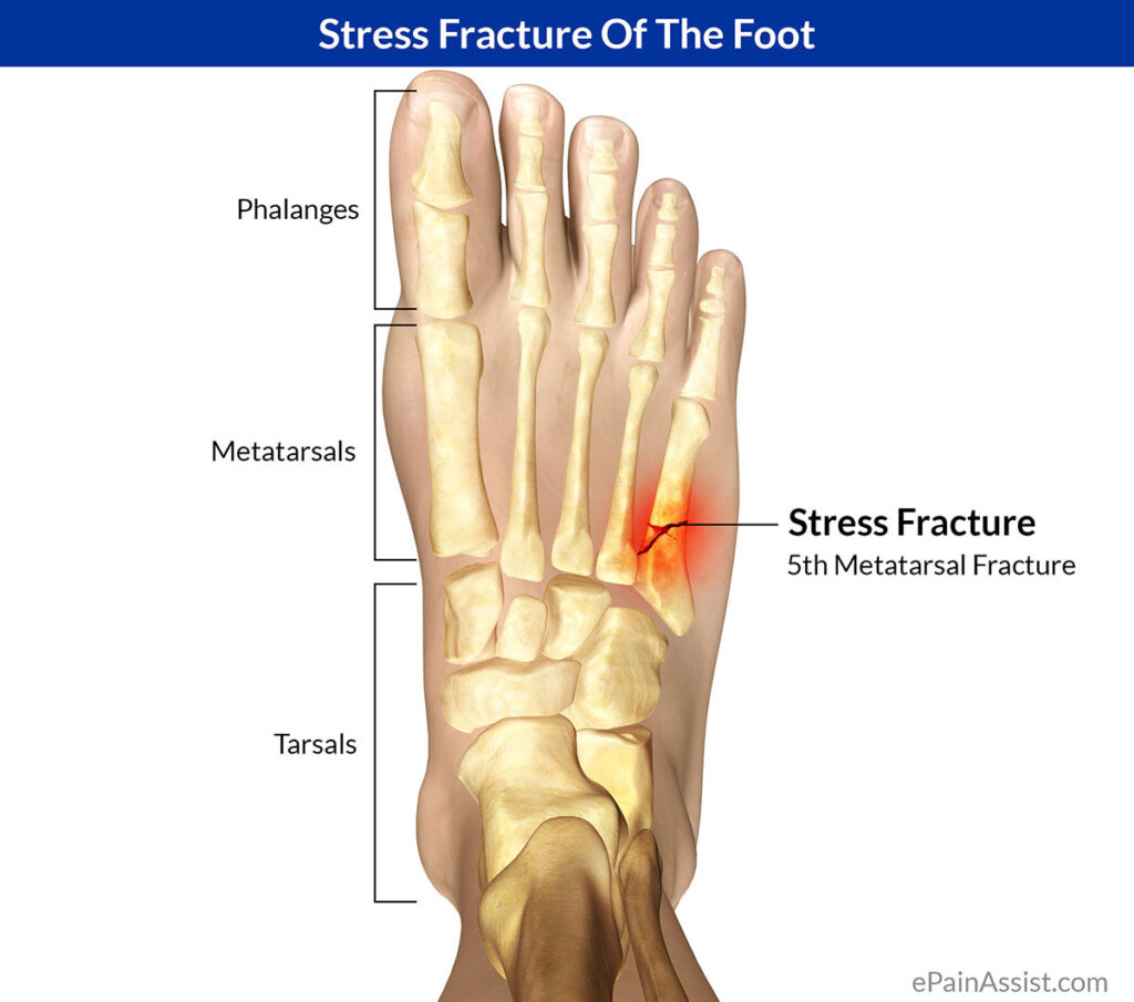 stress fracture